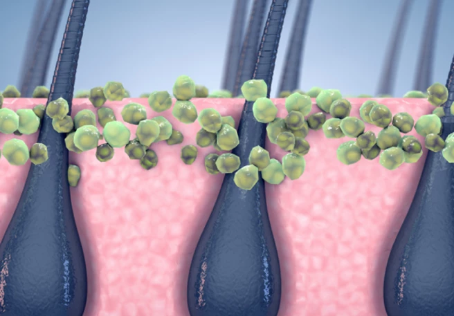 What is Malassezia and how is it related to dandruff?